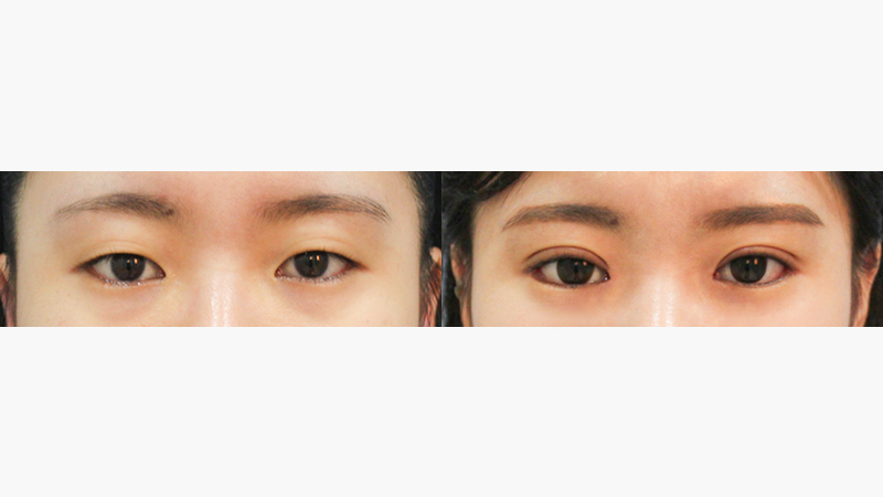 자연유착+뒷트임+밑트임