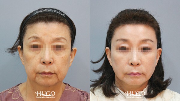 수술 후 3개월