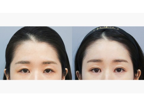 상안검+안검하수+앞트임+밑트임