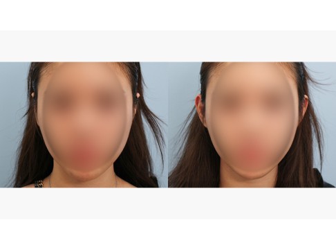 귀필러