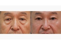 Lower Blepharoplasty
