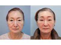 Face&Neck Lift