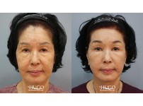 Face&Neck Lift