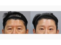 Forehead Lift