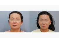 Face&Neck Lift