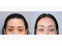 Forehead Lift+Upper Blepharoplasty+Lower Blepharoplasty