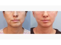 Face Lift