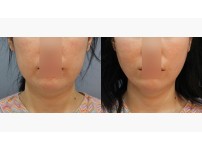 Thread Lift