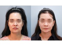 Face&Neck Lift +Nasolabial Fold SMAS Fat Grafting