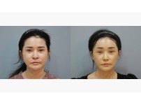 Face&Neck Lift