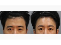 Forehead Lift