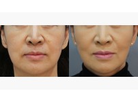 Lower Blepharoplasty