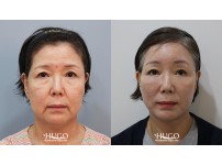 Face&Neck Lift