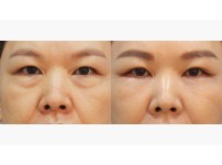 Lower Blepharoplasty