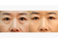 Lower Blepharoplasty