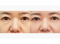 Lower Blepharoplasty