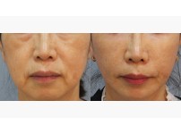 Lower Blepharoplasty