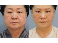 Face&Neck Lift
