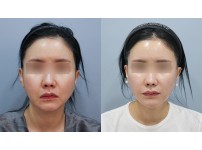 Face&Neck Lift