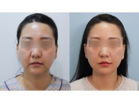 Face&Neck Lift