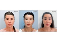 Face&Neck Lift+Forehead Lift