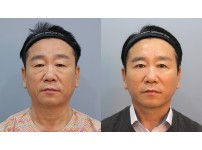 Face&Neck Lift