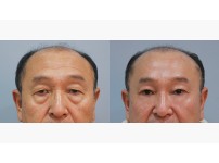 Forehead Lift