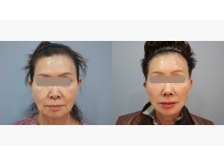 Face&Neck Lift