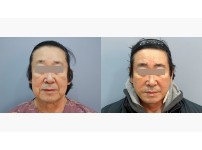 Face&Neck Lift