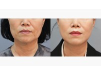 Face&Neck Lift