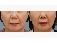Lower Blepharoplasty