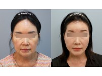 Face&Neck Lift