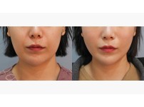 Thread Lift