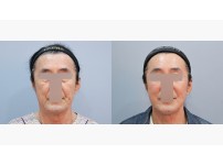 Face&Neck Lift