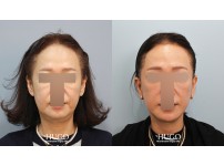 Face&Neck Lift