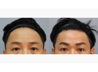 Forehead Lift
