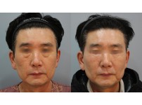 Lower Blepharoplasty