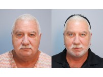 Face&Neck Lift+Submentoplasty+Facial Liposuction