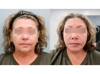 Face&Neck Lift+Forehead Reduction Lift+Submentoplasty