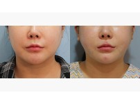 Thread Lift