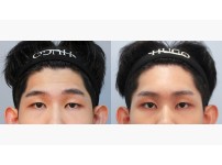 Forehead Lift