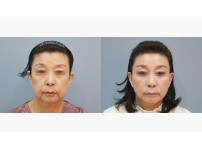 Face&Neck Lift