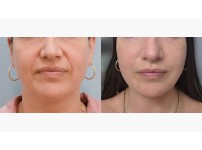 Mini Face Lift +Lower Blepharoplasty + Zip-up Lift (Submento…
