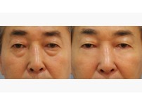 Lower Blepharoplasty