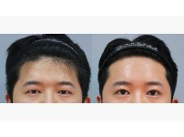 Forehead Lift