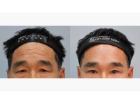 Forehead Lift